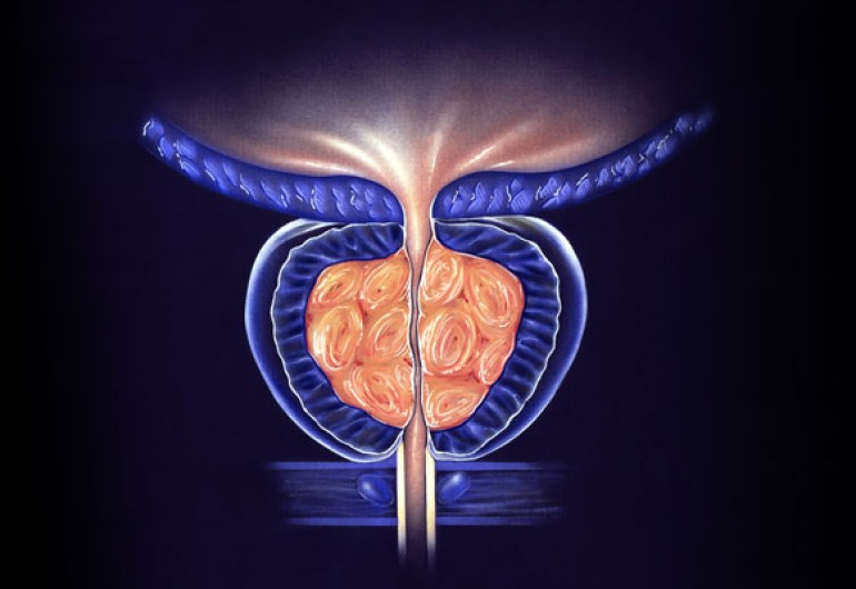 Benign prostatic hyperplasia (BPH)