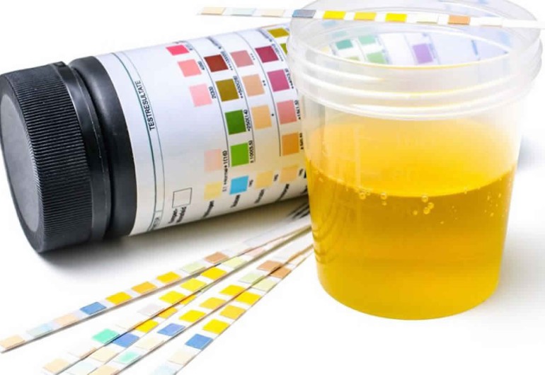 Protein in urine (proteinuria)
