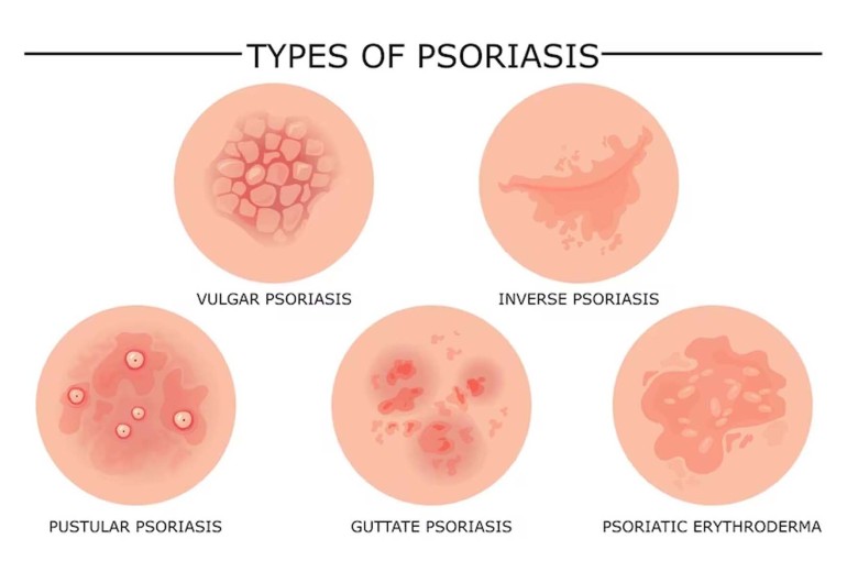 Psoriasis