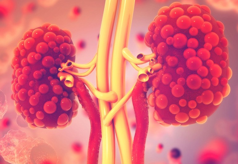 Acute kidney failure