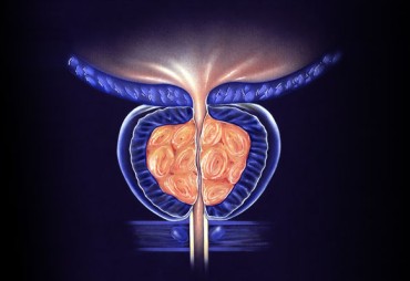 Benign prostatic hyperplasia (BPH)