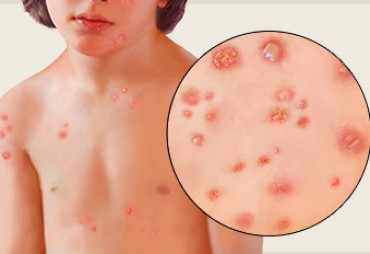 Chickenpox