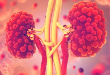 Acute kidney failure